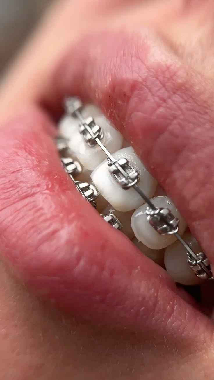 Close-up of orthodontic braces