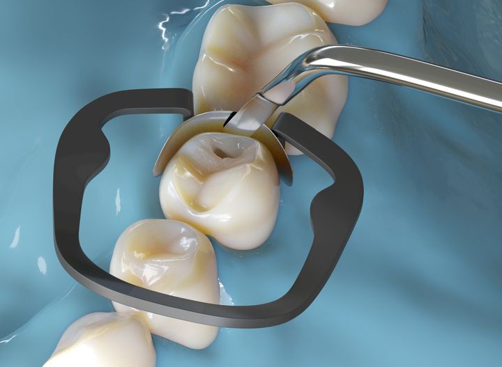 Restorative dental procedure on a tooth