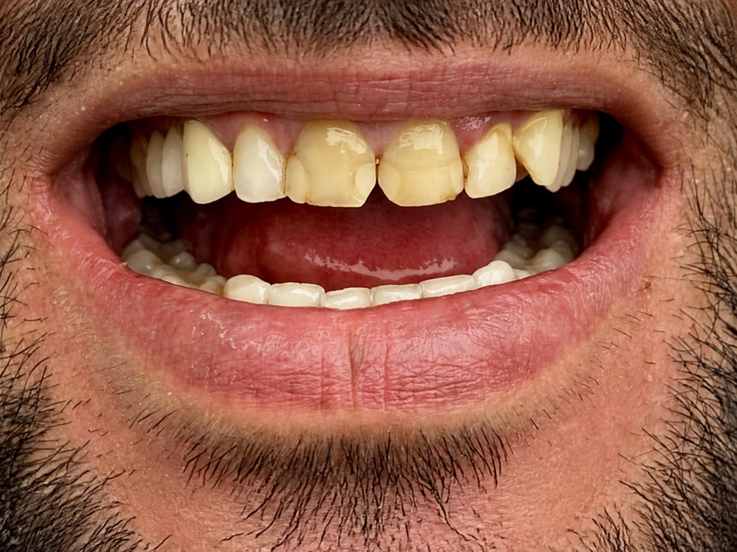 Patient's smile before treatment